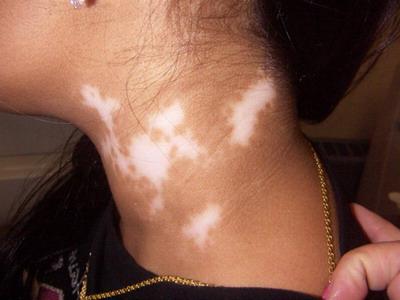 어린이 vitiligo
