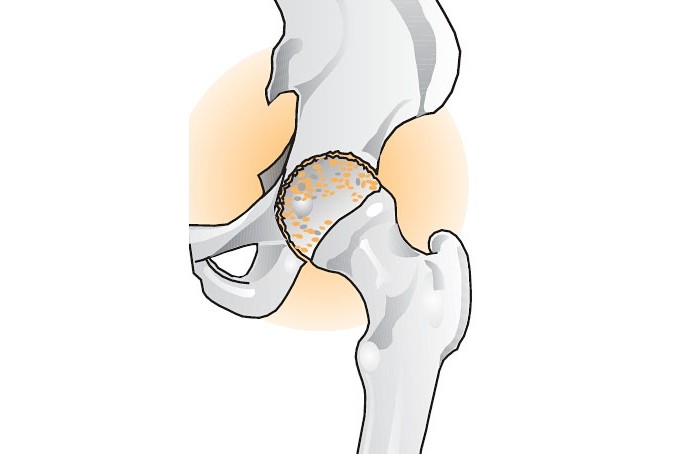 coxarthrosis를 민간 요법으로 치료하는 방법은 무엇입니까?