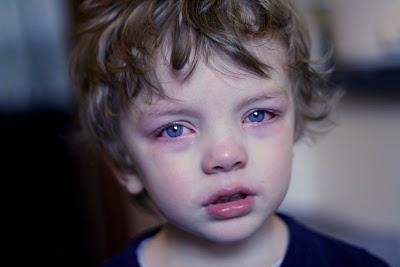 아이의 빨간 눈 : 원인, 치료 및 예방