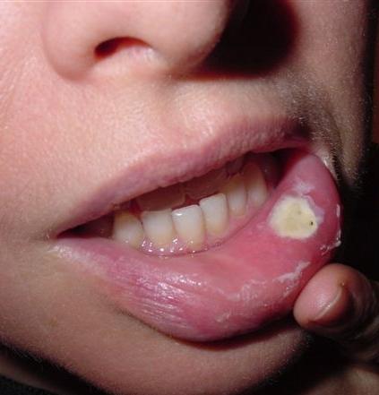 립 암의 증상 - 어떻게 인식합니까?