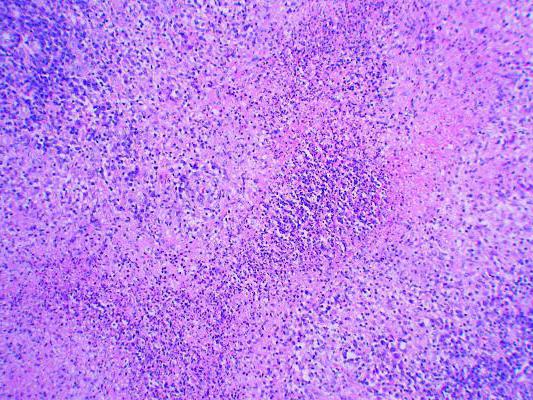 Venereal lymphogranuloma : 치료의 설명, 원인, 증상 및 특징